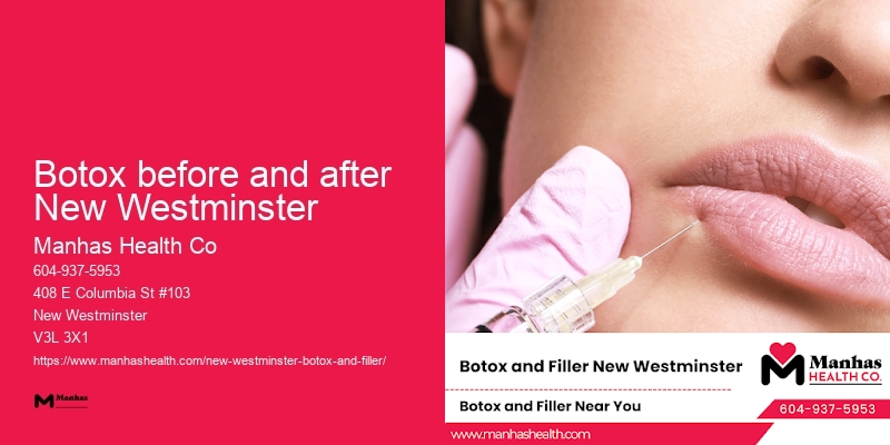 Botox for facial wrinkles Botox before and after New Westminster