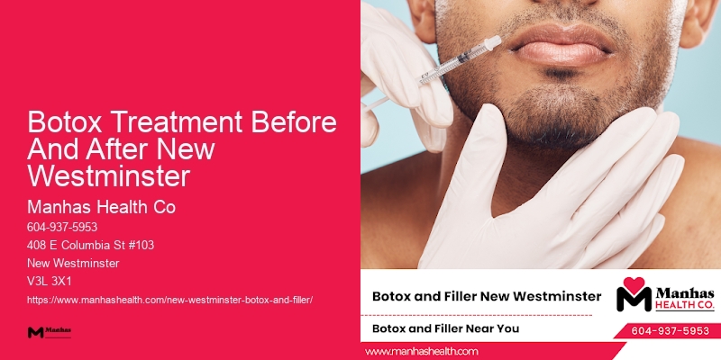 Botox effects Botox Treatment Before And After New Westminster